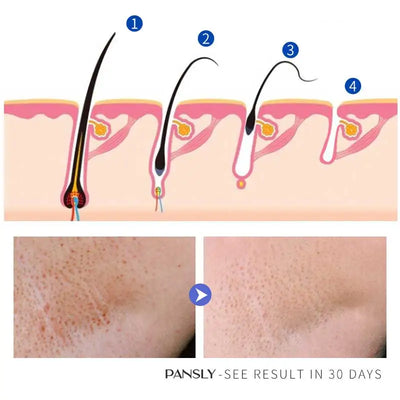 PANSLY Hair Inhibitor Stop Hair Growth Removal Permanent Beard Bikini Intimate Legs Body Armpit Lotioin Painless Depilatory 50g